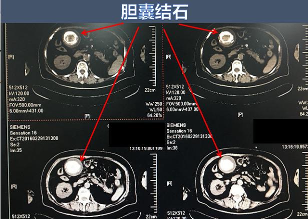 小胆囊也会有大麻烦！关于胆结石的3件事，你不妨了解一下