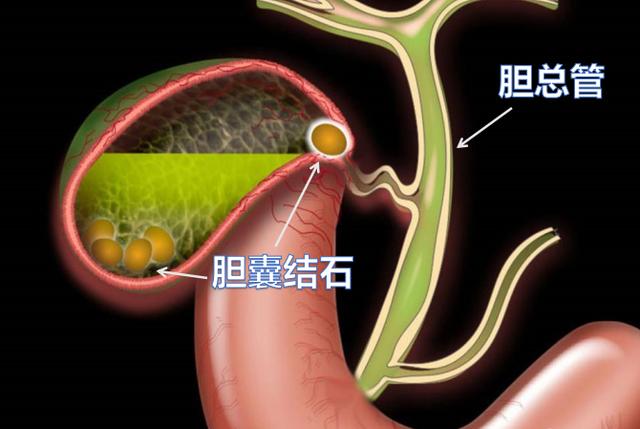 小胆囊也会有大麻烦！关于胆结石的3件事，你不妨了解一下