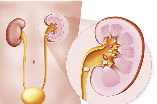 什么样的人易患“结石”？小心这6种结石让人“痛不欲生”！