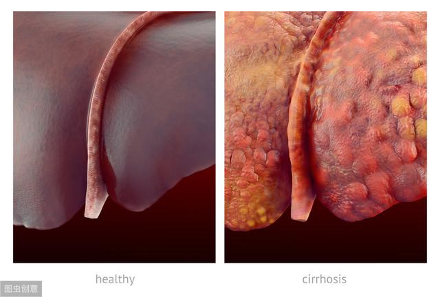 治疗肝硬化的四大药物类型、用药的五大注意事项，专家这样说！