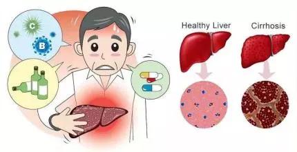 【争议】肝硬化患者能不能吃海鲜？？