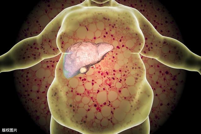 得了脂肪肝不可怕，牢记4个饮食原则，脂肪肝会慢慢“消失”的