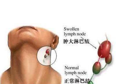 肺不好的人，有“2处凸起，3处发黑”，若一个没有，肺部还算健康