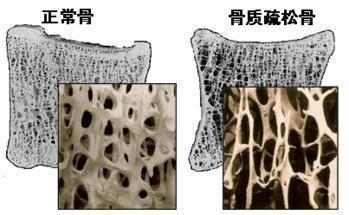 你知道吗，其实骨头汤、虾壳不补钙！请收下这份食物补钙排行榜