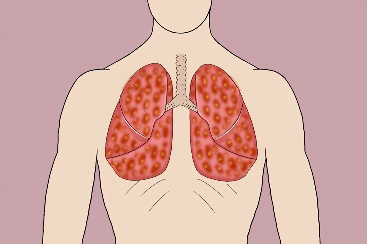 身体出现5种情况，或是提示肺功能不正常，日常做好2件事养好肺